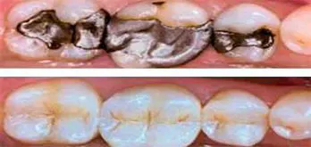 Curaciones Dentales