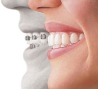blanqueamientos dentales lima Centro Odontológico Neodentis - Dentistas en Lima, Perú