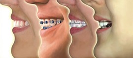 blanqueamientos dentales lima Centro Odontológico Neodentis - Dentistas en Lima, Perú